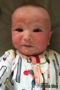 An Infection In Addition To Eczema
